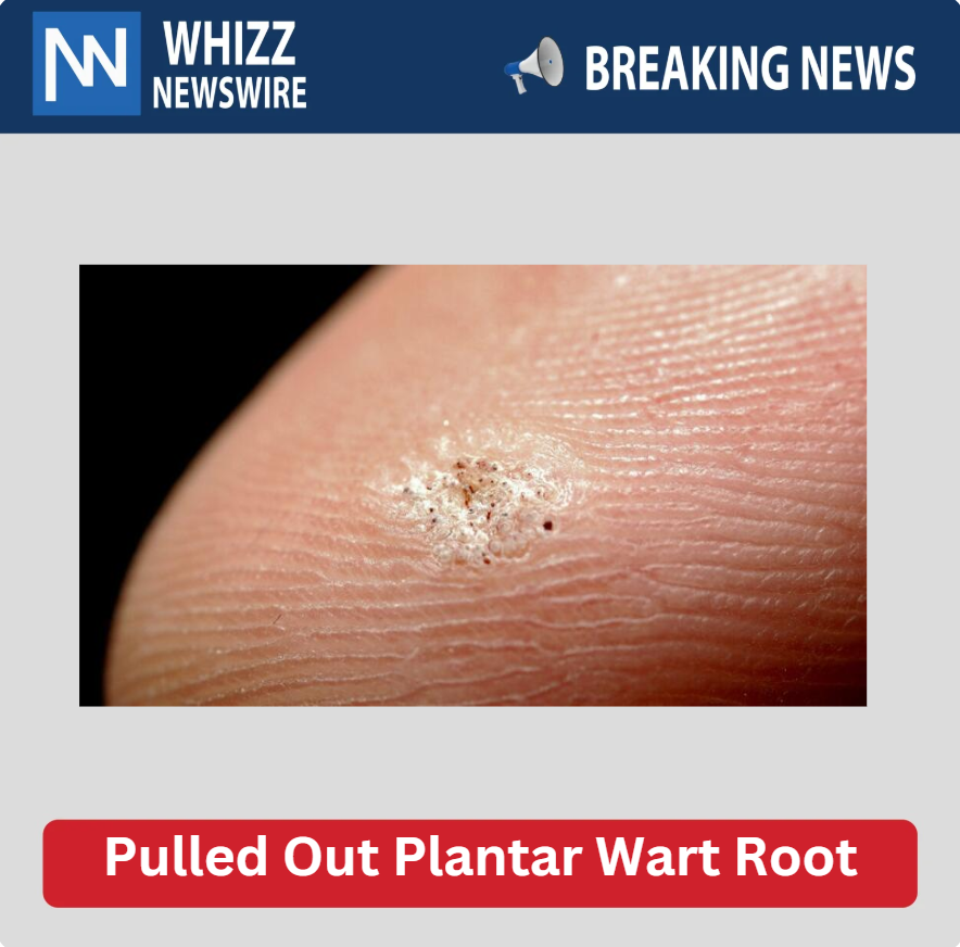 Pulled Out Plantar Wart Root
